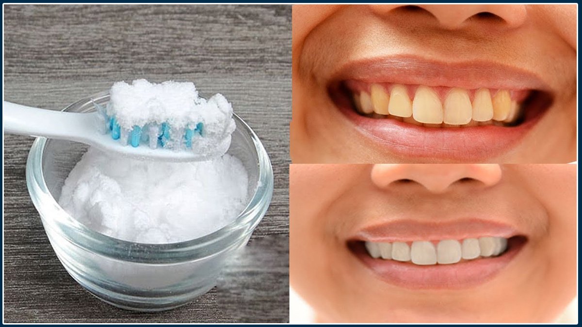 TOP 5 Home Remedies to Whiten Your Teeth Naturally in tamil