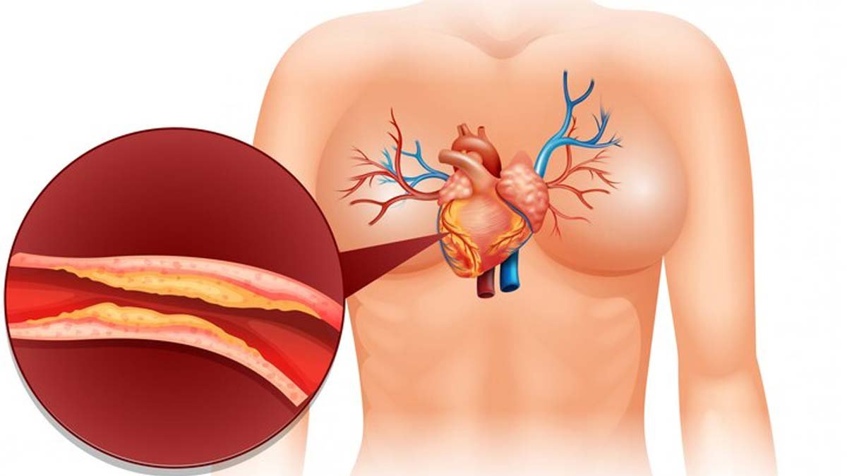 Signs that bad cholesterol is increasing in the body in tamil