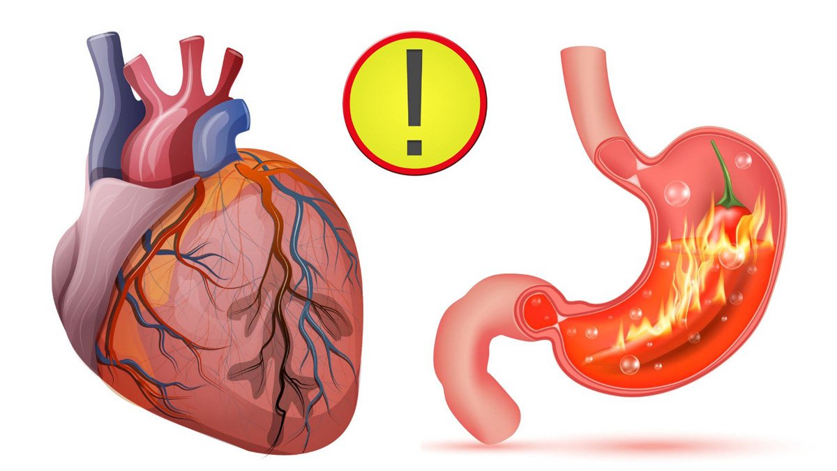 What are the differences between heartburn and heart attack